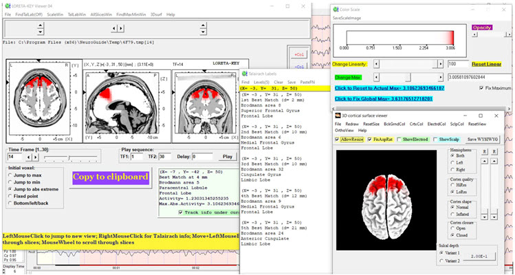 Figure 12 - Baseline eyes-open z-score LORETA analysis for 14 Hz
